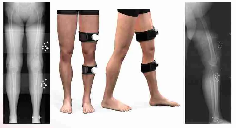 Preoperative Planning Rosa Knee Replacement Preoperative Planning Rosa Knee Replacement