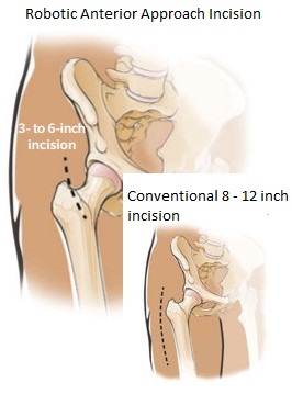 Anterior Hip Incision Size Anterior Hip Incision Size