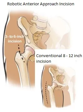 Anterior Hip Incision Size