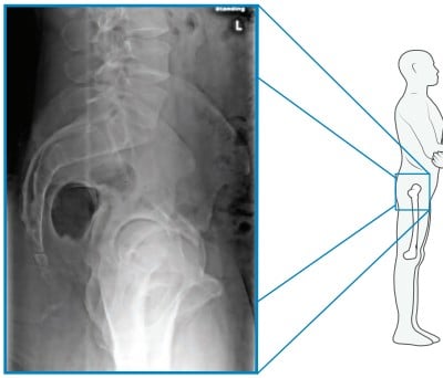 Preop Standing Xray Preop Standing Xray