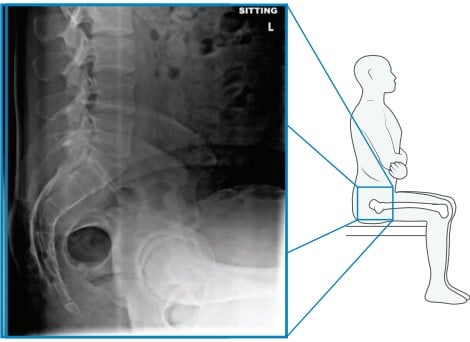 Preop sitting xray Preop sitting xray