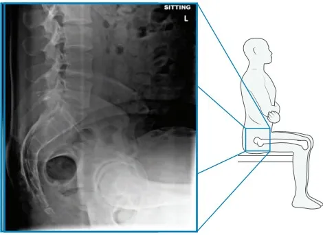 Preop sitting xray