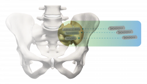 SI Joint Fusion