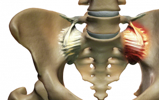 SI Joint Pain 2