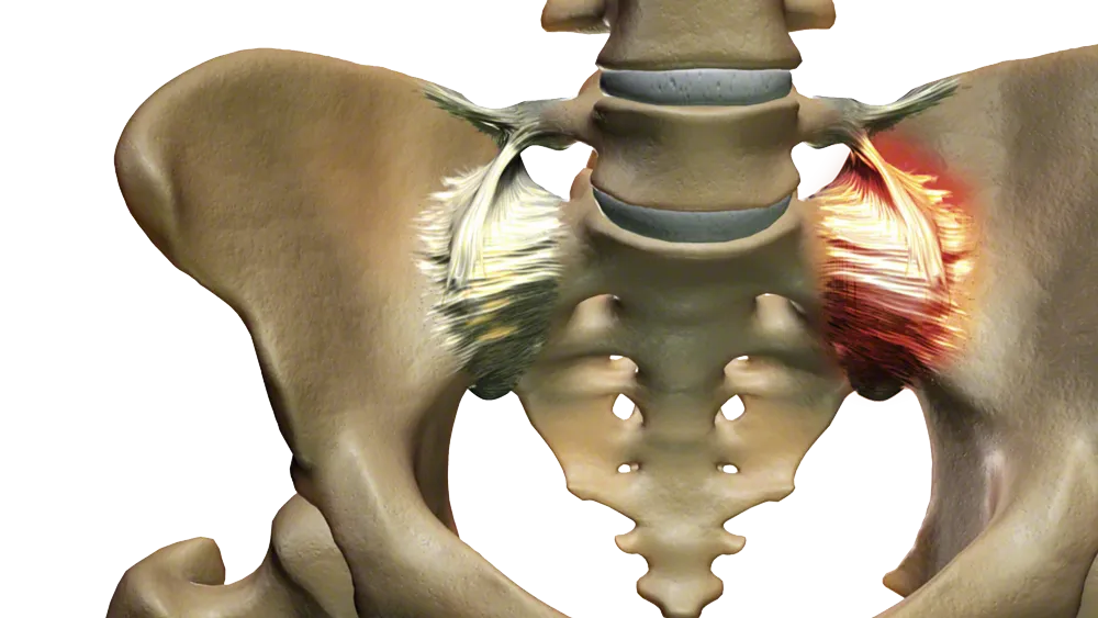 SI Joint Pain SI Joint Pain