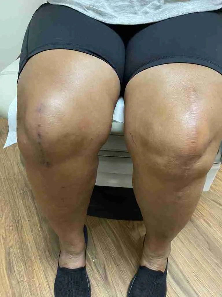 Total Knee Scar Comparison Sitting