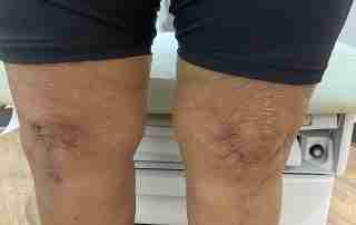 Total Knee Scar Comparison Standing
