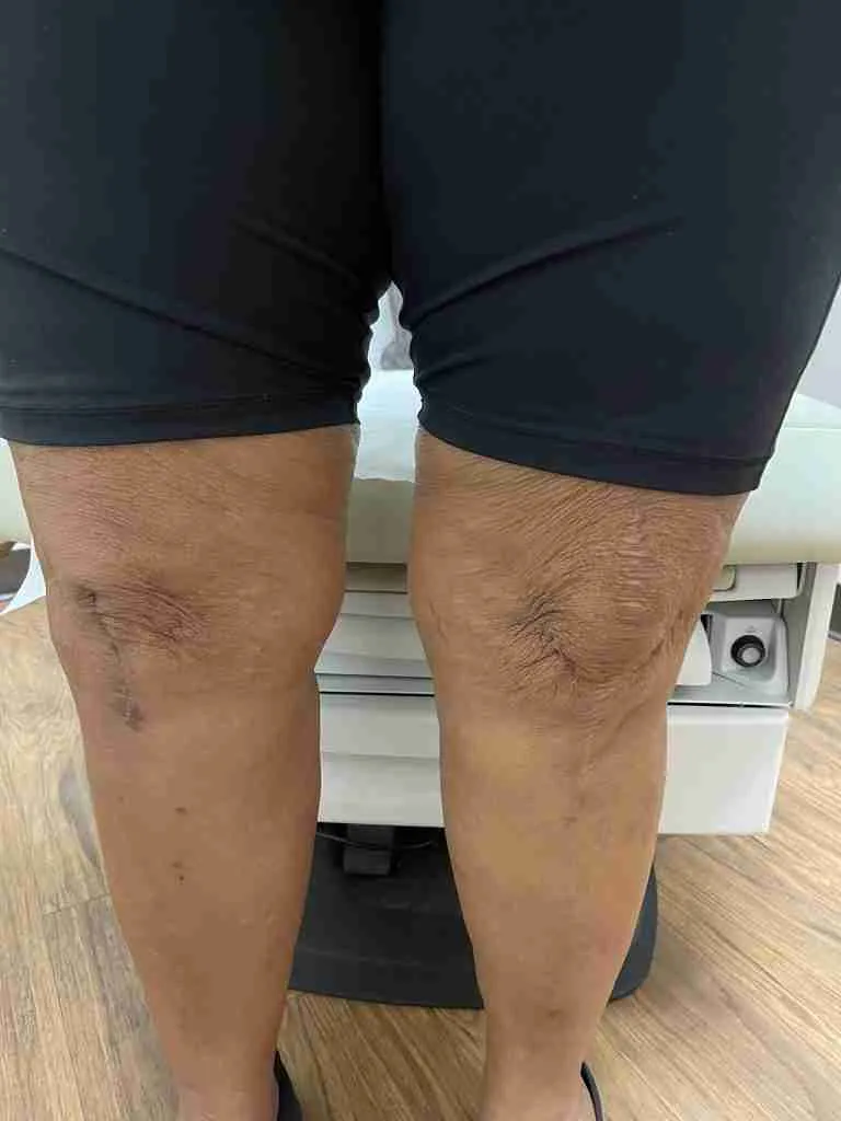 Total Knee Scar Comparison Standing