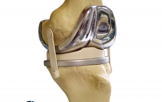 How long does a knee replacement last