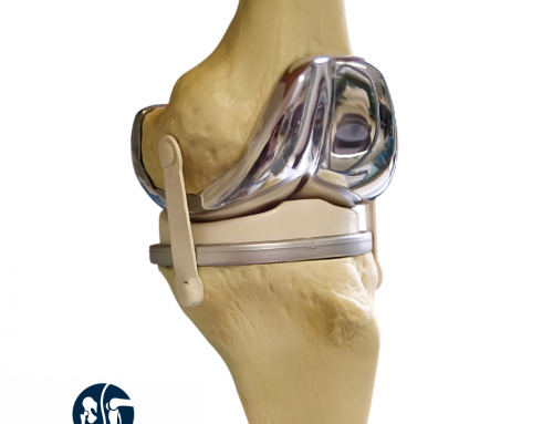 Durability of Knee Replacement Implants