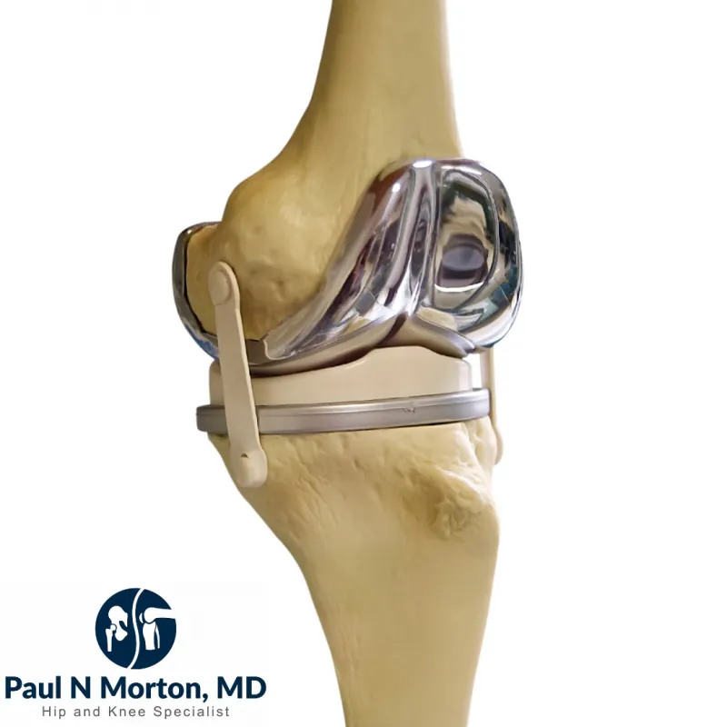Durability Of Knee Replacement Implants Dr. Paul Norio Morton, MD