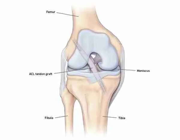 Anterior Cruciate Ligament Injury 5