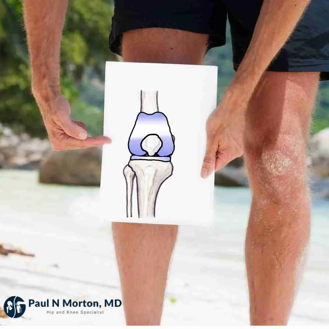 Am I Too Young For a Knee Replacement Am I Too Young For a Knee Replacement
