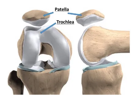 Patellofemoral Joint Arthroplasty 10 download 1