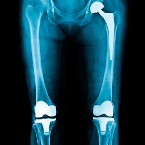 Hip and Knee X rays