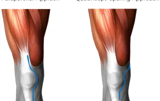 Minimally Invasive Approach to a Total Knee Replacement With the Quadriceps Sparing Approach e1716777826286