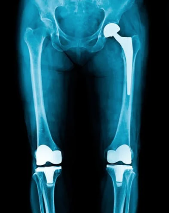 Hip and Knee Replacements Hip and Knee Replacements