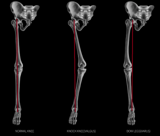 Varus Valgus Normal knee