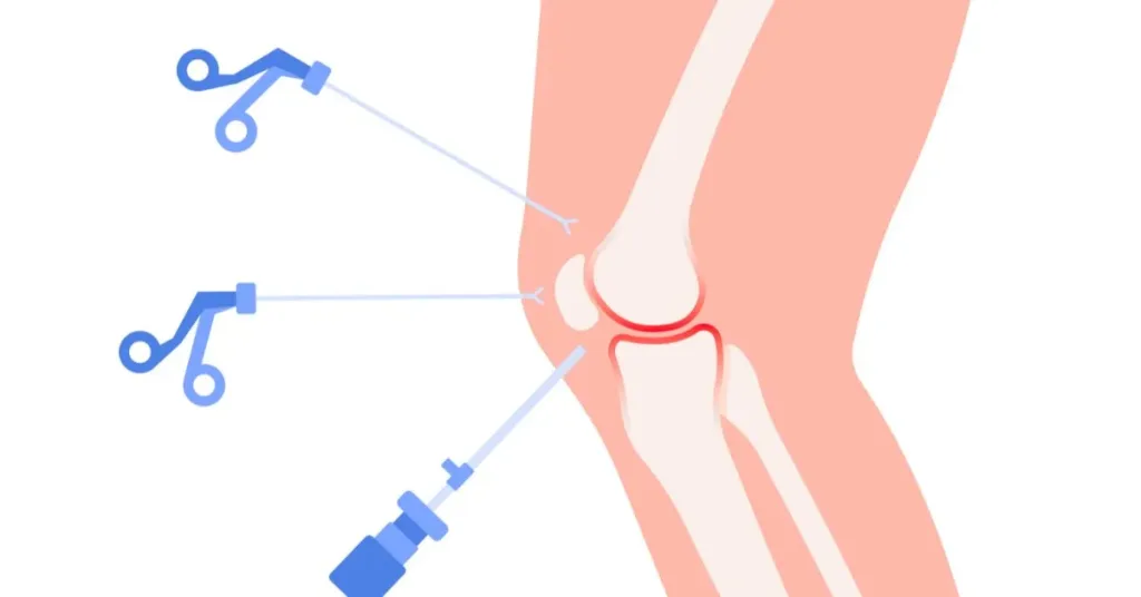 The Role of PRP in Meniscus Repair Surgery in 2025 8 How PRP Is Prepared 1 2