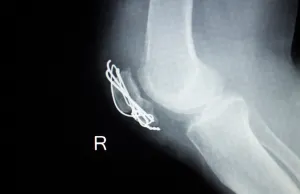 Patella Fracture Malunion Patella Fracture Malunion
