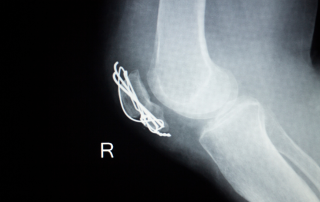 Patella Fracture Malunion