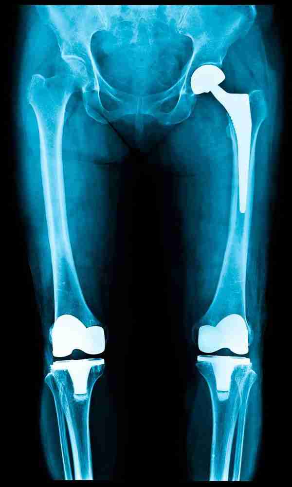 Hip Or Knee Replacement Cost 3