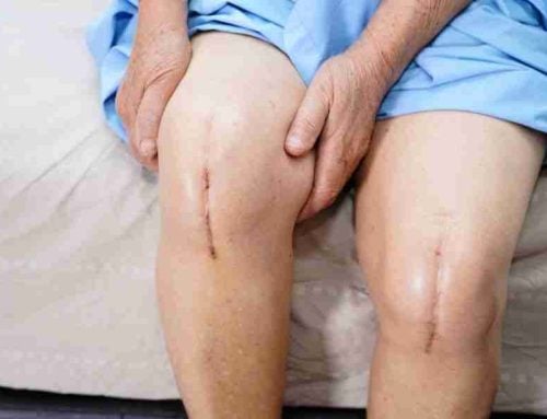 How Much Does A Hip Or Knee Replacement Cost?
