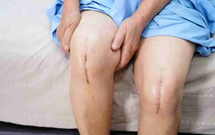 Partial Knee Replacement Surgery 58 Hip Or Knee Replacement Cost