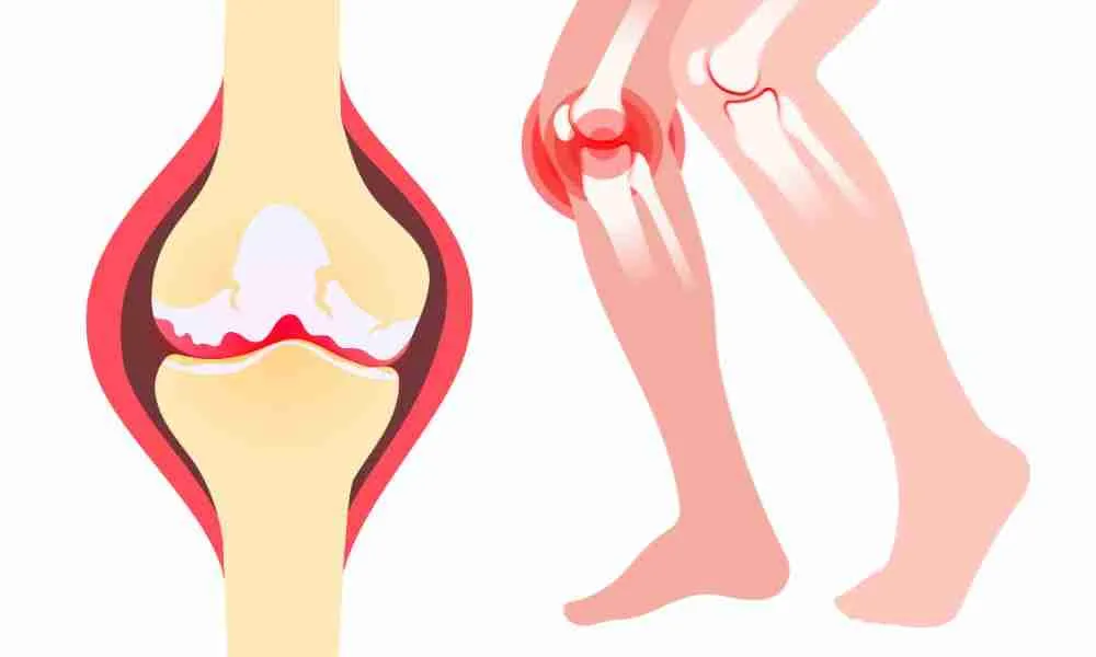 Knee Arthritis 1