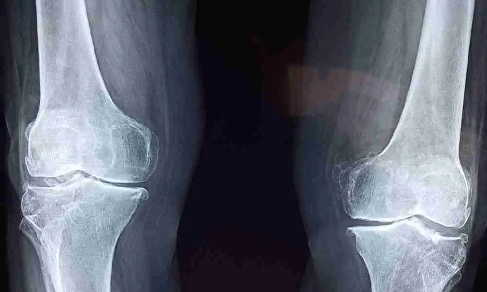 Knee Arthritis