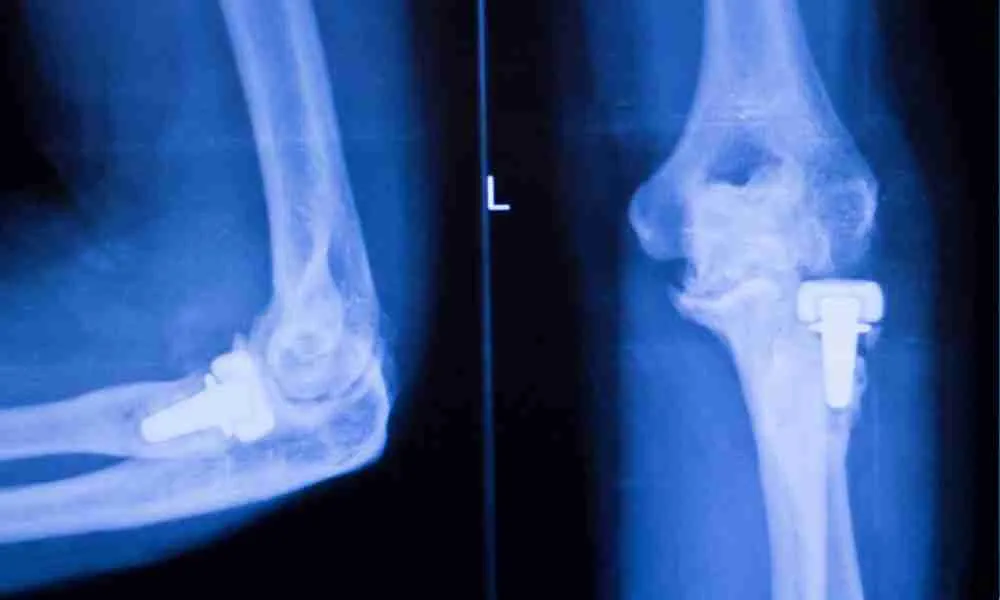 Recalled Joint Implants: Essential Insights Patients Should Know 9 Overview of Joint Implants 2