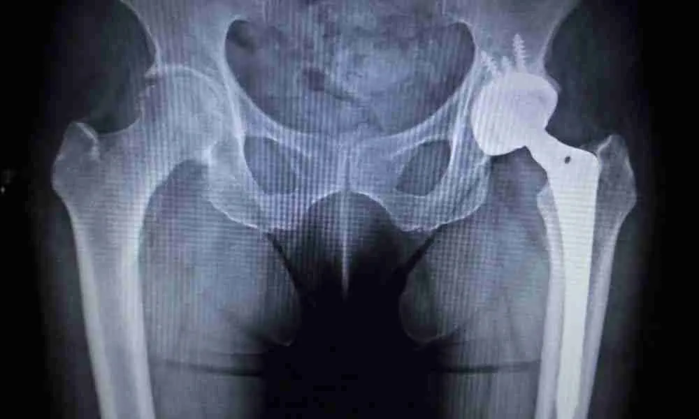 Overview of Joint Implants