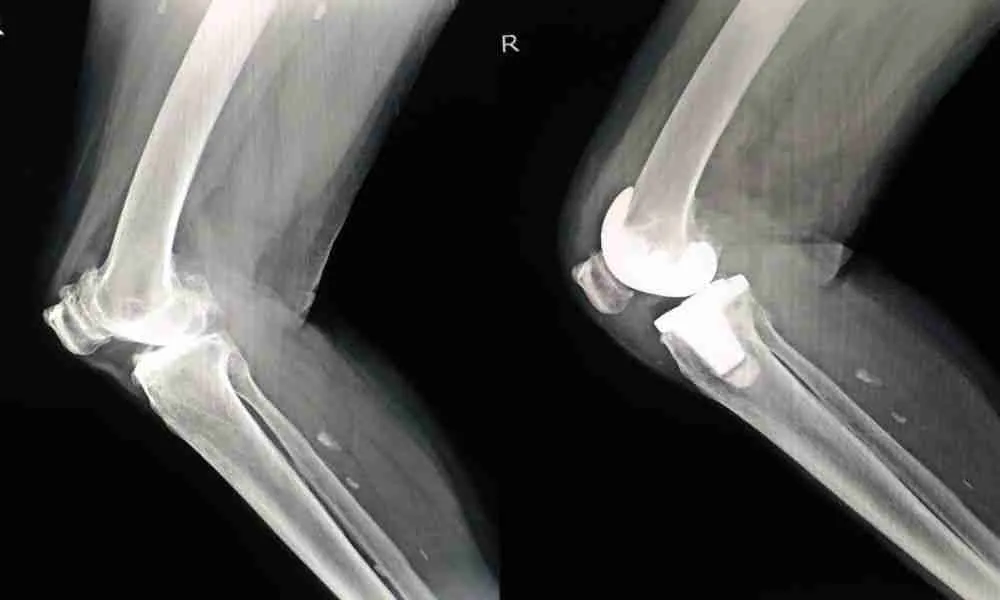 Transforming Knee Surgery 1