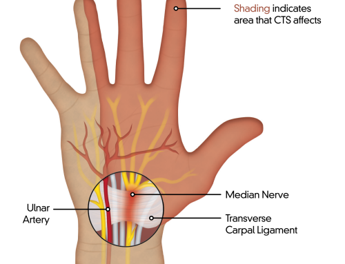 Ultrasound-Guided Carpal Tunnel Surgery in Honolulu, Hawaii